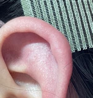 耳洞發炎紅腫